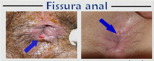 Fissura anal