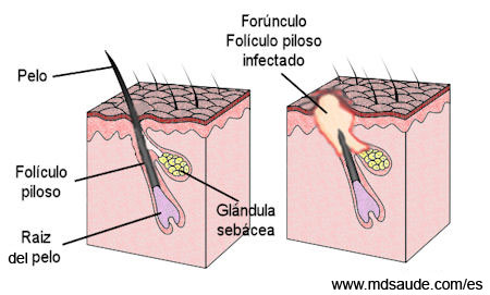 Forúnculo