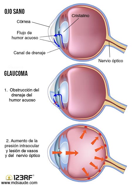 Cómo surge el glaucoma