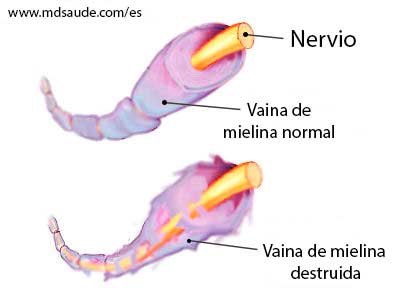 Guillain-Barré - Vaina de mielina atacada por autoanticuerpos