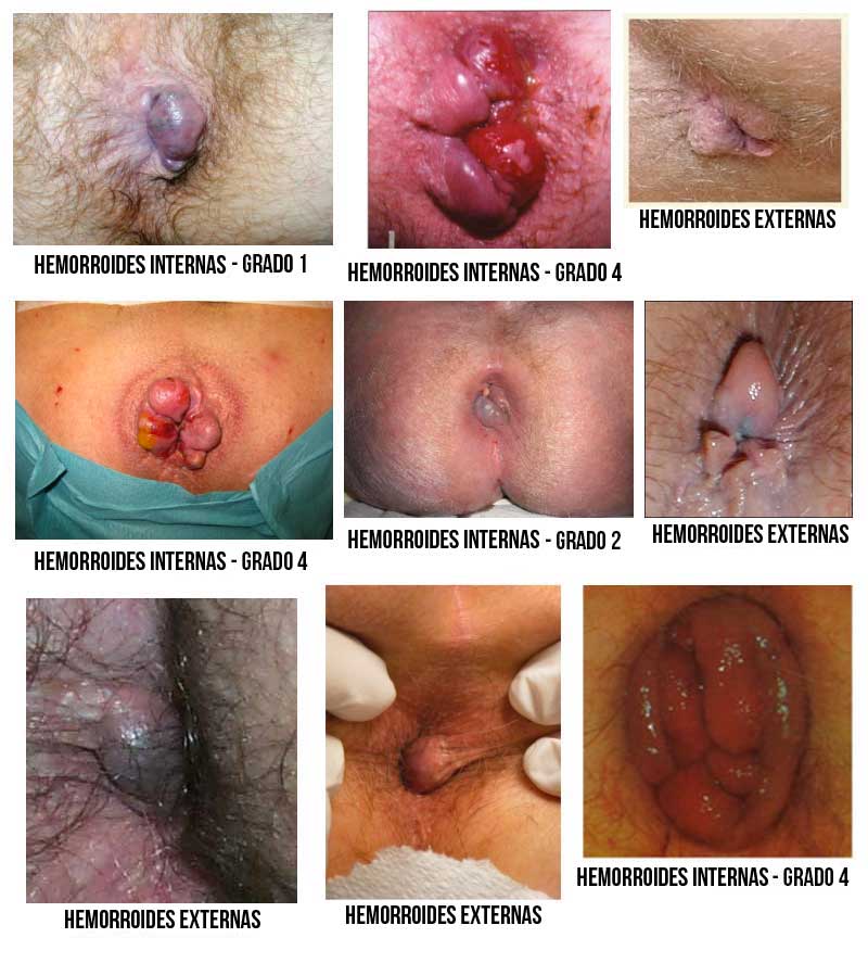 Hemorroides-fotos