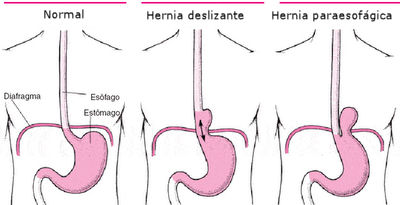 Hernia de hiato