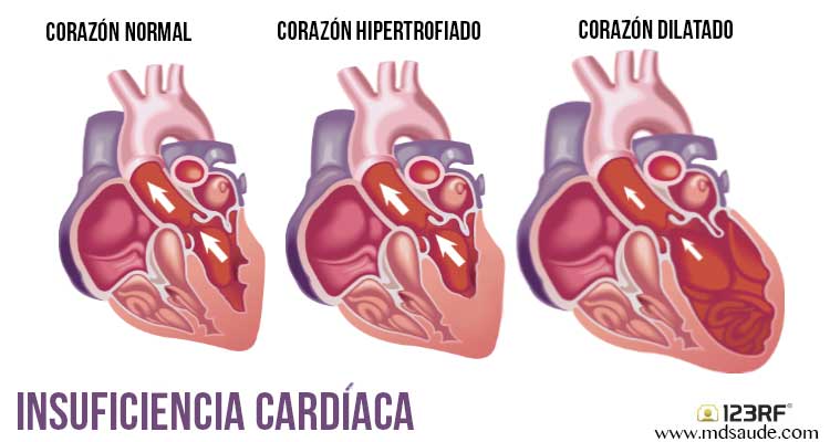 insuficiencia cardíaca