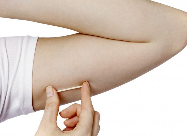 Método anticoncepcional: implante contraceptivo