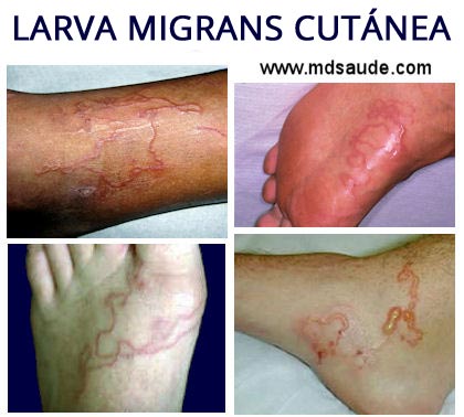 Lesiones típicas de larva migrans