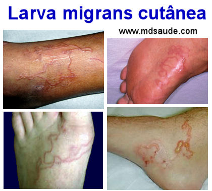 Lesões típicas de larva migrans