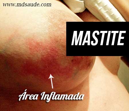 Mastite da amamentação