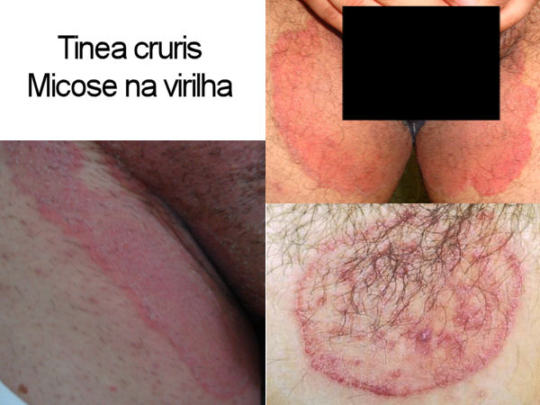 Tínea