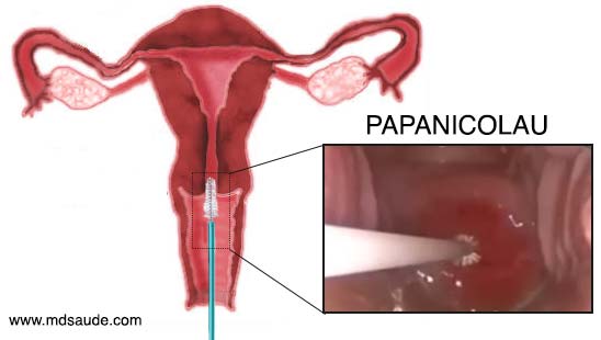 Papanicolau