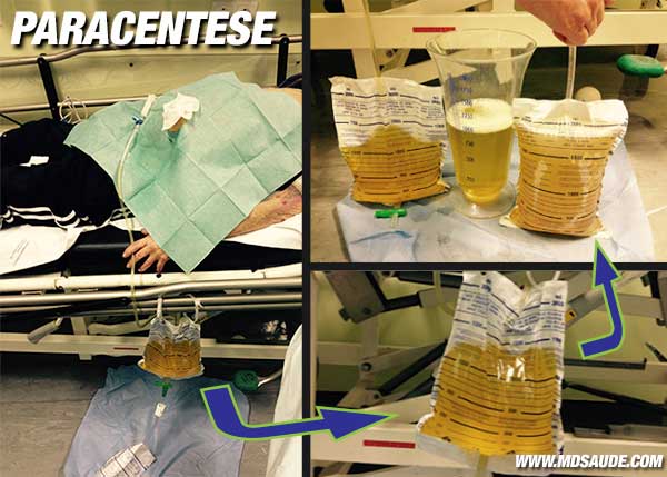 Paracentese: drenagem do líquido ascítico