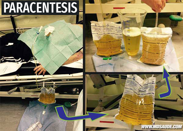 Paracentesis y el líquido ascítico.