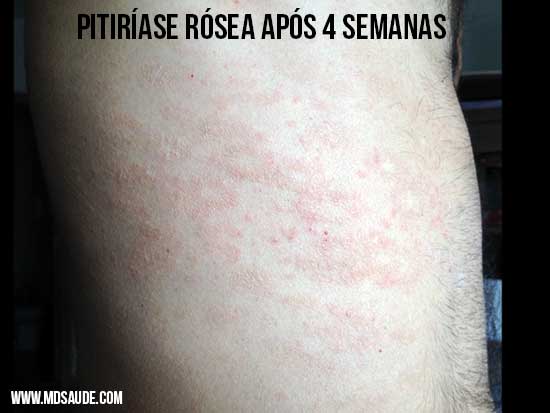 Pitiríase rósea: um mês de evolução