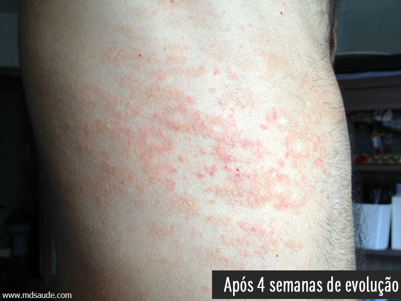 Pitiríase rósea após 1 mês