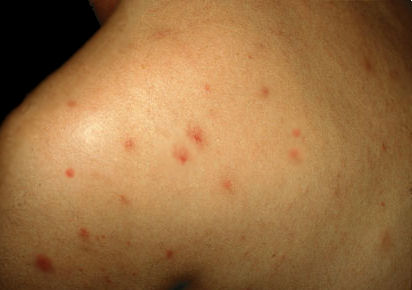 Rash HIV