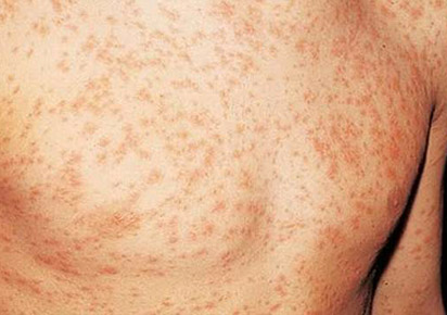 Rash de pele do HIV agudo