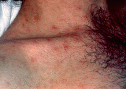 Rash de pele do HIV