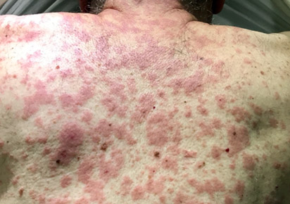 Rash do HIV no tronco