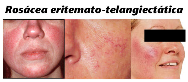Rosácea eritematosa-telangiectásica