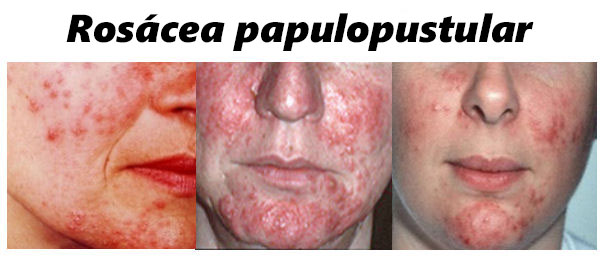 Rosácea pápulo-pustulosa