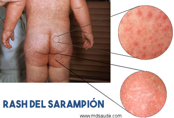 Sarampión