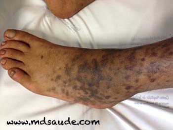Sarcoma de Kaposi