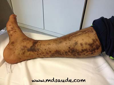 Sarcoma de Kaposi