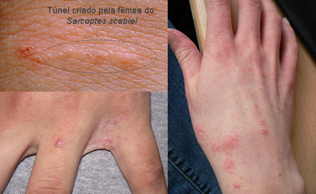 Lesões da sarna - imagens
