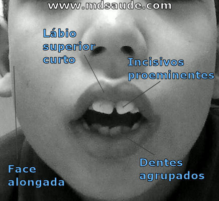 Fácies adenoideana