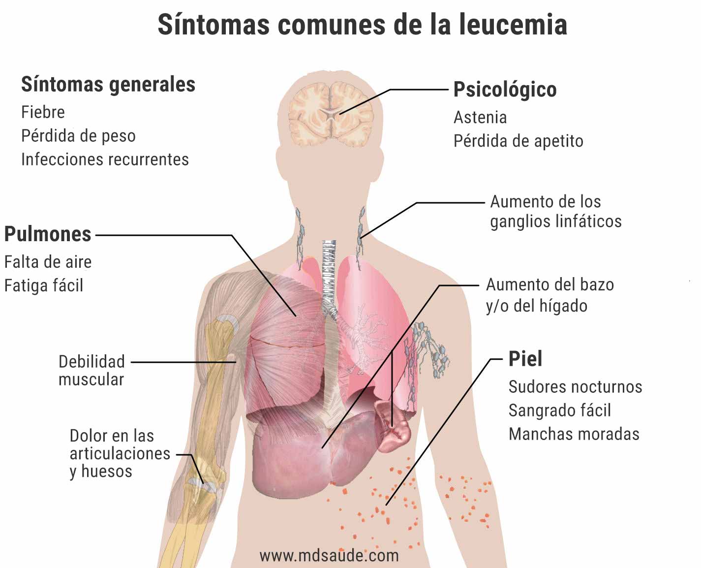 Síntomas comunes de la leucemia