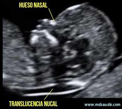 translucencia nucal