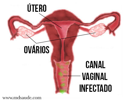 Vaginosis bacteriana