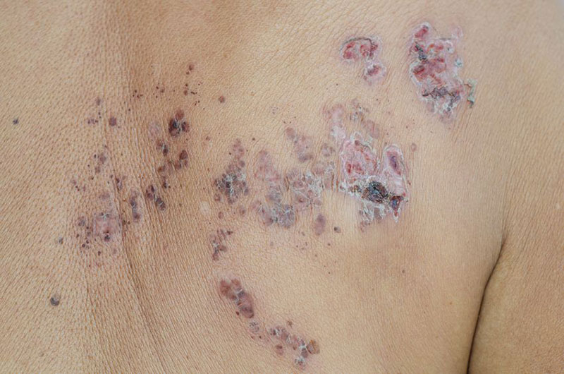 Herpes zoster lesions in the process of healing