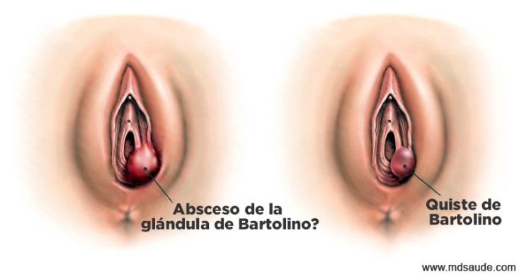 Absceso y quiste de Bartolino