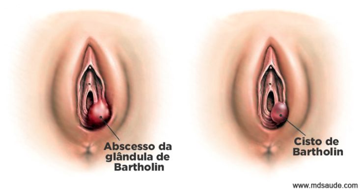 Abscesso e cisto de Bartholin