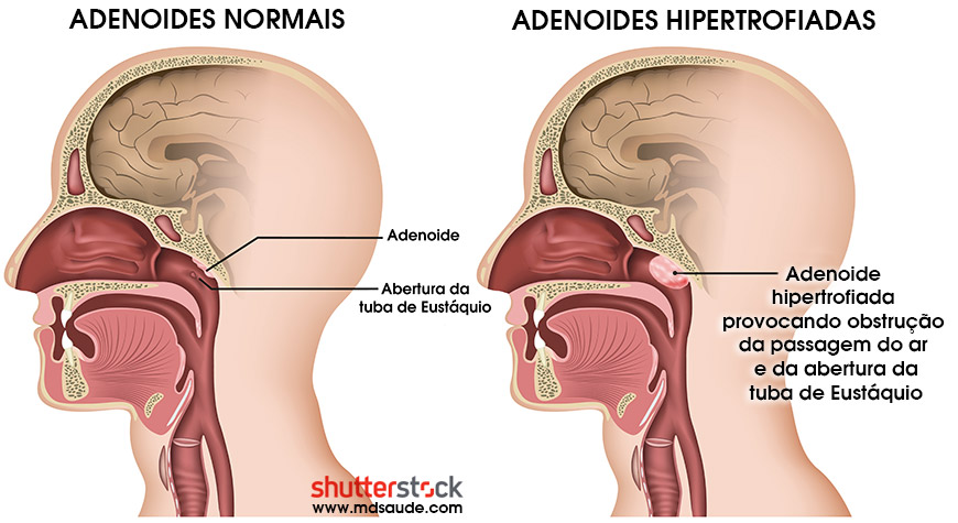 Adenoides