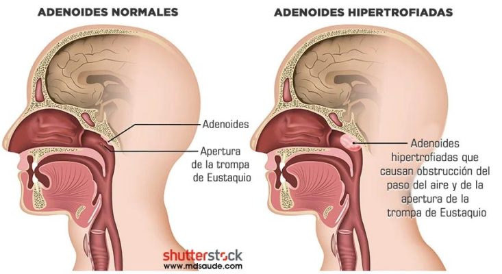 Adenoides hipertrofiadas que causan obstrucción del paso del aire y apertura de la trompa de Eustaquio