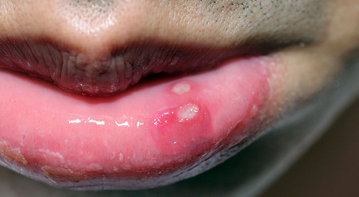 Dos aftas en el labio inferior causadas por un traumatismo (mordedura accidental)