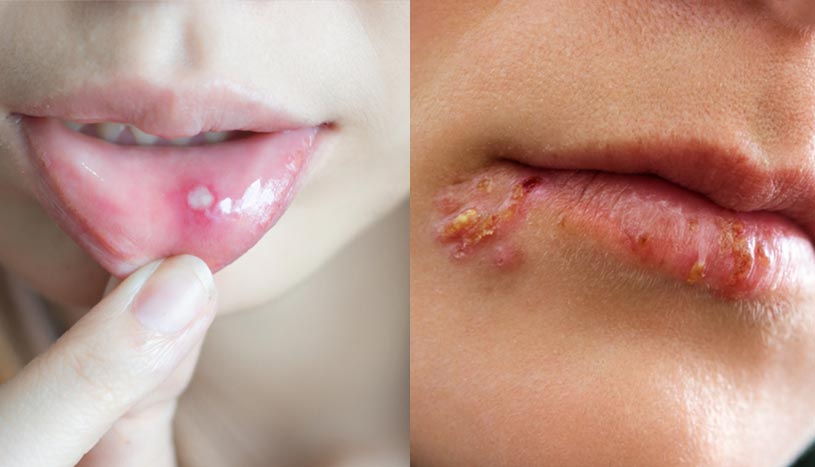 Diferenças entre afta e herpes labial (com imagens)