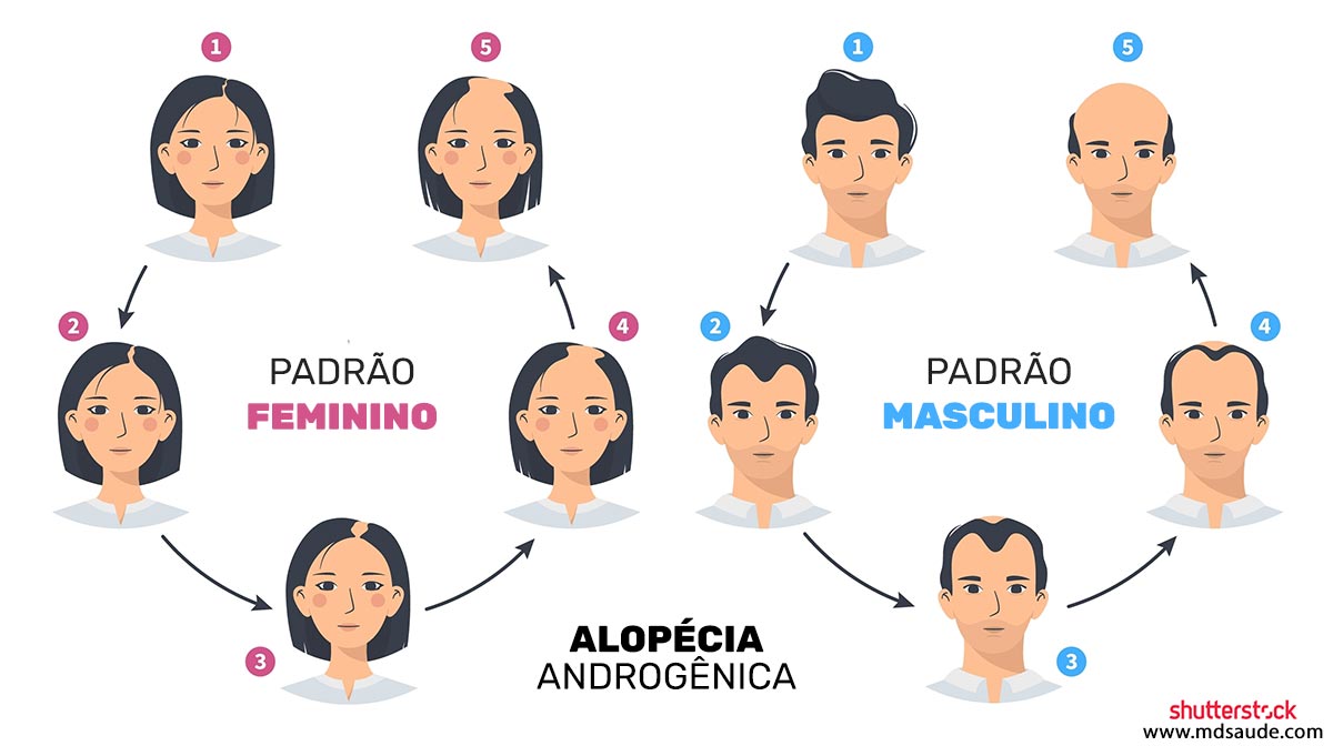 Padrões de alopecia androgenética: queda de cabelo em homens e mulheres