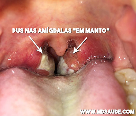 Amigdalite com pus em manto - mononucleose