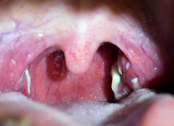 Amigdalite bacteriana com pus nas amígdalas