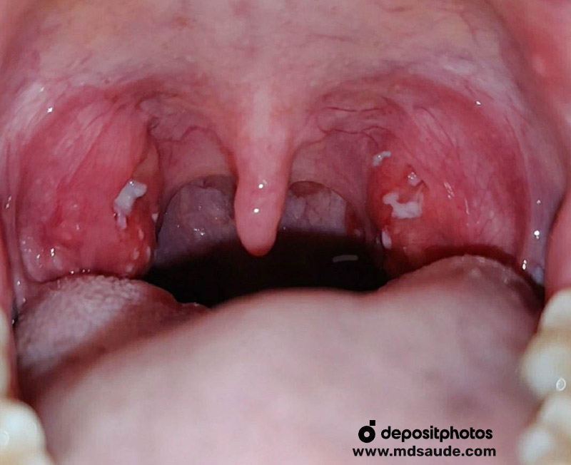 Amigdalite bacteriana: hiperemia e pus nas amígdalas