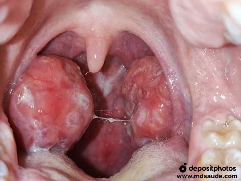 Faringoamigdalite bacteriana: amigdalas inchadas, hiperemia e pus.