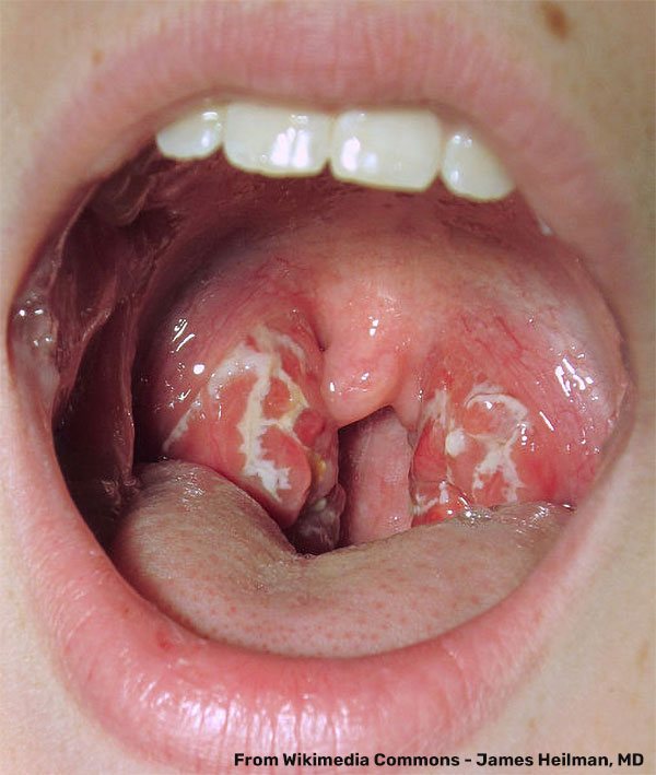 Tonsillitis