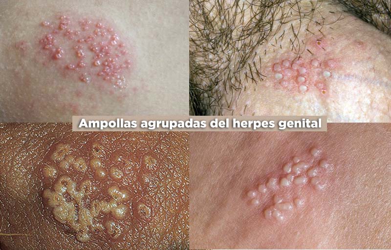 Etapa inicial: ampollas de herpes genital