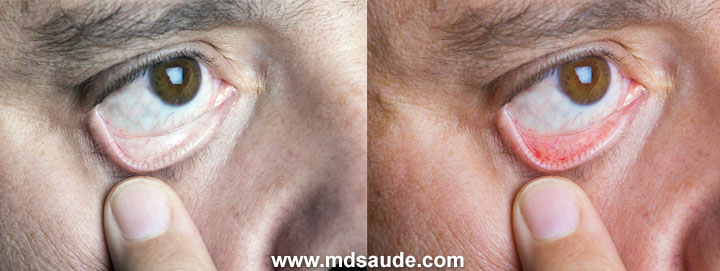 Anemia: conjuntiva pálida e conjuntiva corada (sem anemia).