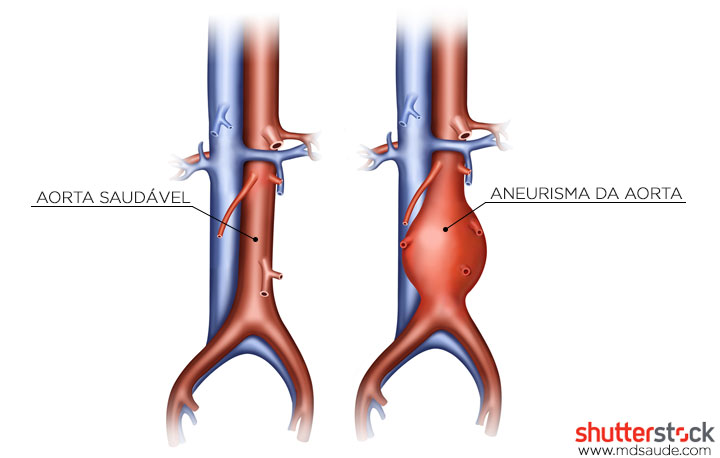 Aneurisma da aorta