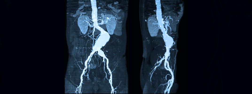 Aneurisma da aorta