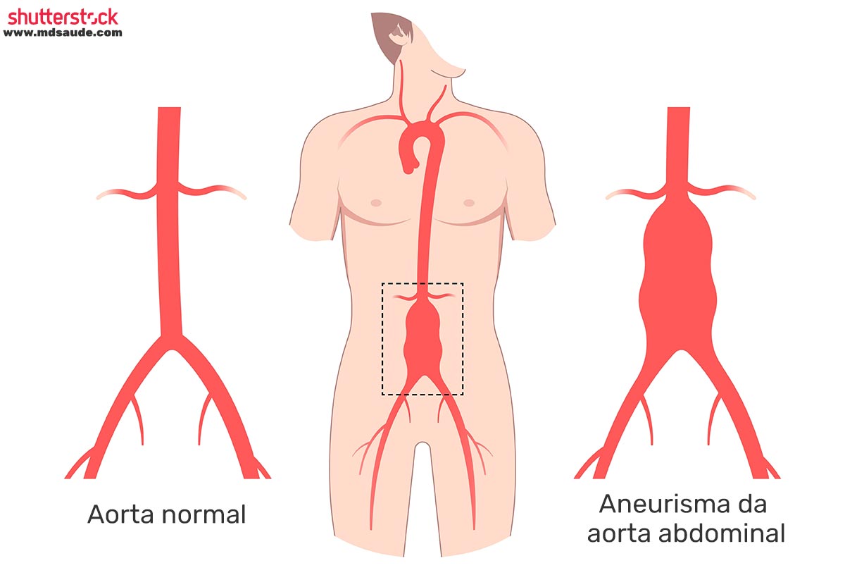 Aneurisma da aorta abdominal