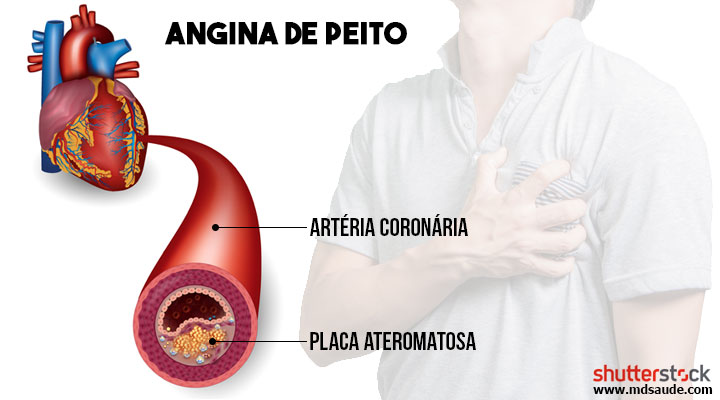 Angina - doença ateromatosa das artérias coronárias